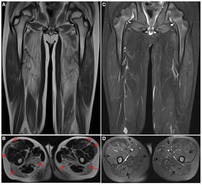 Case Report: ISPD Gene Mutation Leads to Dystroglycanopathies: Genotypic Phenotype Analysis and Treatment Exploration
